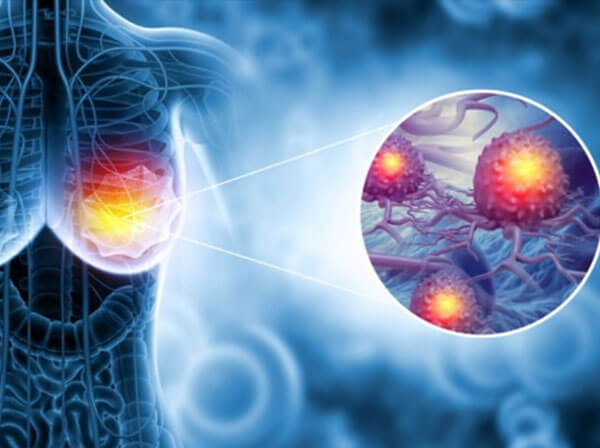 Breast Cancer Treatment