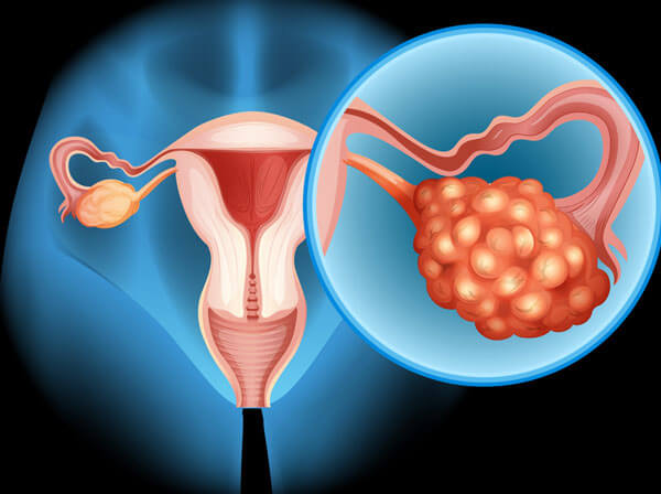 Ovarian Cancer