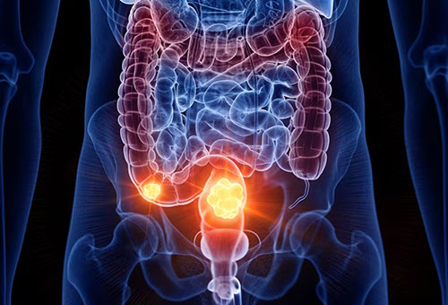 Genitourinary Cancer