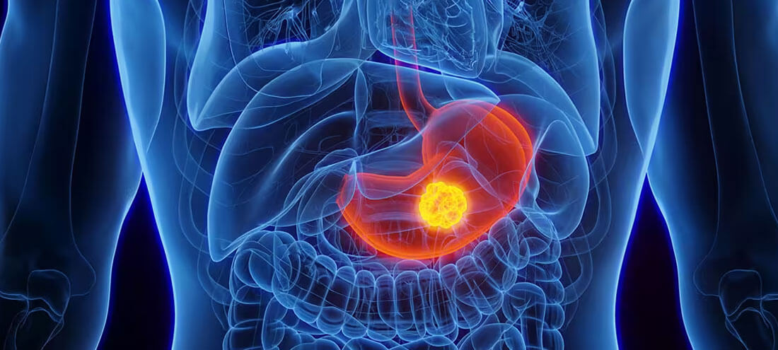 Gastrointestinal Cancer