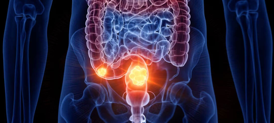 Genitourinary Cancer